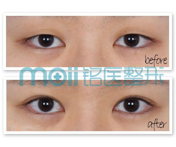 对比图,长春好的整形医院