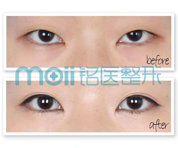 双眼皮,对比图,长春好的整形医院