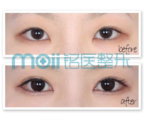 双眼皮,对比图,长春好的整形医院