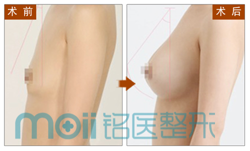 丰胸,隆胸,对比图,长春好的整形医院