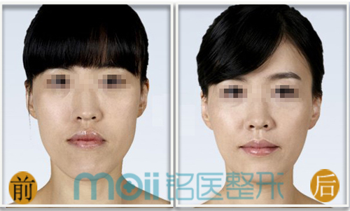 瘦脸针,对比图,长春好的整形医院