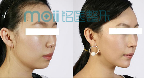 玻尿酸,隆下巴,对比图,长春好的整形医院