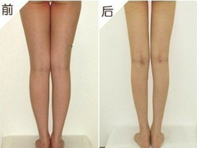 大腿部吸脂