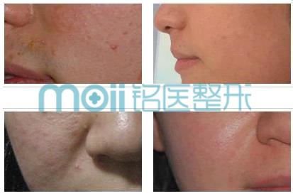 激光,祛痘,对比图,长春好的整形医院