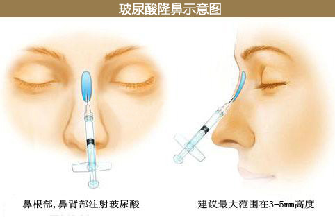 玻尿酸,隆鼻,长春好的整形医院