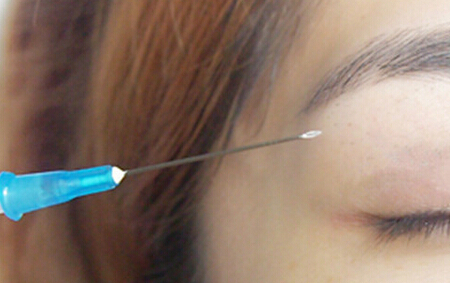 双眼皮,埋线,过程,吉林铭医