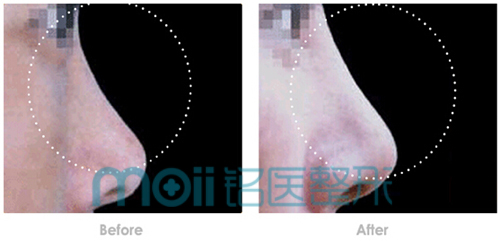 玻尿酸,隆鼻,对比图,长春好的整形医院