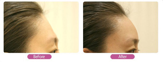 丰额头,对比图,长春好的整形医院