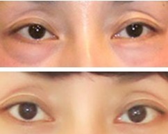 祛眼袋手术疗效至少可以持续多少年?