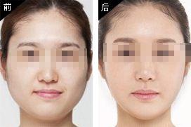 长春吸脂,瘦脸,铭医