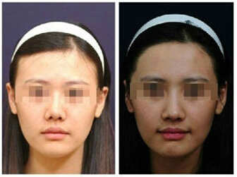 鼻综合整形,对比图,长春好的整形医院