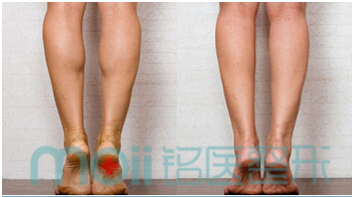 botox,瘦小腿,对比图,长春好的整形医院