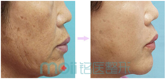 BOTOX,除皱,对比图,长春好的整形医院