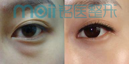 眼袋,对比图,长春好的整形医院