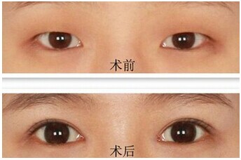 眯眯眼救星:开眼角术