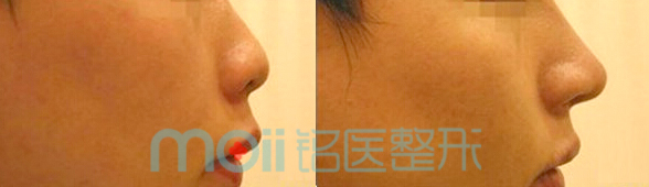 自体软骨隆鼻治疗方式全解析