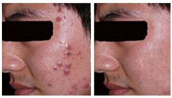 长春治疗痤疮好的医院是哪一家?