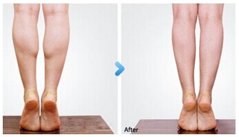 小腿黄金曲线吉林铭医瘦腿针雕塑