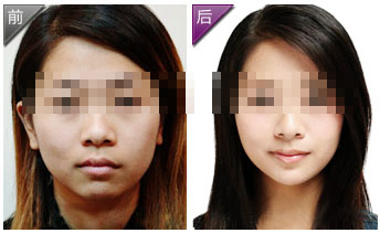 注射瘦脸 帮你做精致新娘