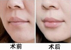 玻尿酸丰唇 缔造性感双唇