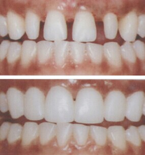 牙齿瓷贴面的优点是什么