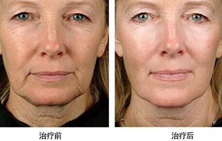 自体脂肪注射除皱的独特之处