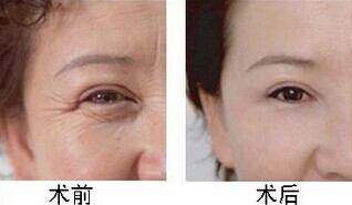 动态皱纹的杀手:肉毒素