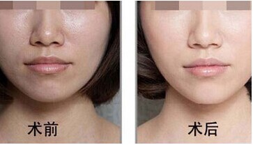 光子嫩肤修复受损肌肤有奇效