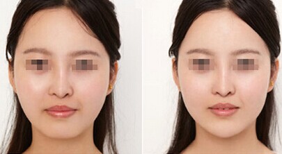 玻尿酸垫下巴后可以正常吃饭吗？