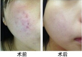 面对激光去痘印 你准备好了吗？