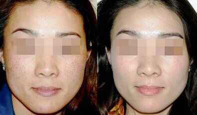 激光祛斑 持久无斑