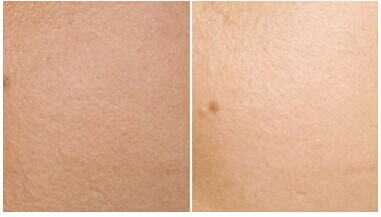 光子嫩肤一站式解决毛孔粗大问题