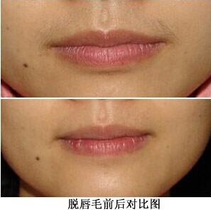 激光脱唇毛 展现女人柔美