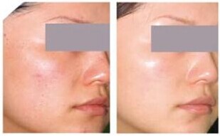 光子嫩肤可以治疗皮肤暗黄吗？