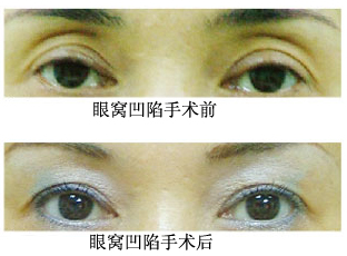 两大微整让凹陷的眼窝重新鼓起来