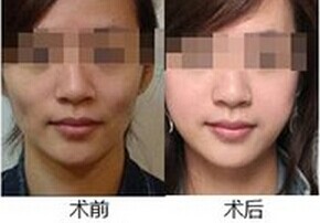 丰太阳穴从细节塑造美丽容颜