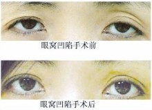 拒绝衰老 两招告别眼窝凹陷