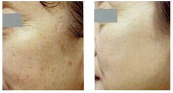 激光去老年斑会不会反弹?