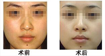 激光嫩肤,对比图,长春好的整形医院