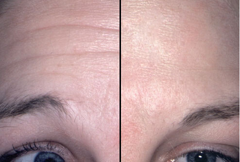 抬头纹,肉毒素,对比图,长春好的整形医院