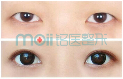 双眼皮,开眼角,对比图,长春好的整形医院