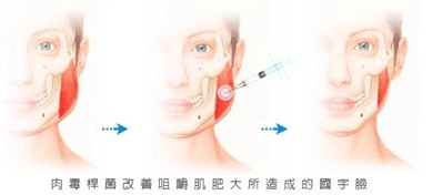 瘦脸,BOTOX,瘦脸针,长春好的整形医院