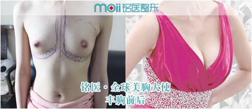 隆胸,假体,对比图,长春好的整形医院