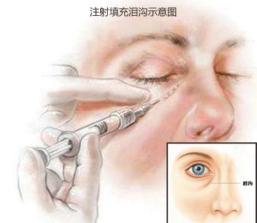 注射,填充,泪沟,示意图,长春好的整形医院