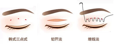 双眼皮,手术,方式,长春好的整形医院