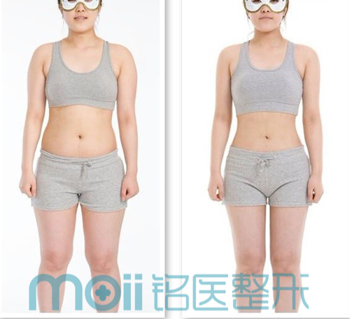 吸脂,瘦身,对比图,长春好的整形医院
