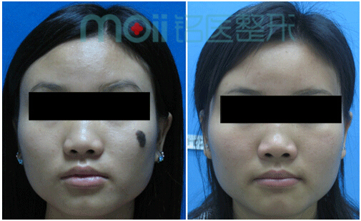激光去痣,对比图,特价,长春好的整形医院