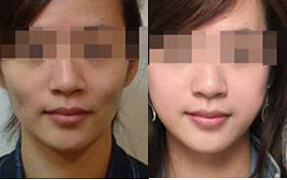 自体脂肪,丰面颊,对比图,长春好的整形医院