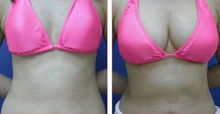 自体脂肪,丰胸,对比图,长春好的整形医院