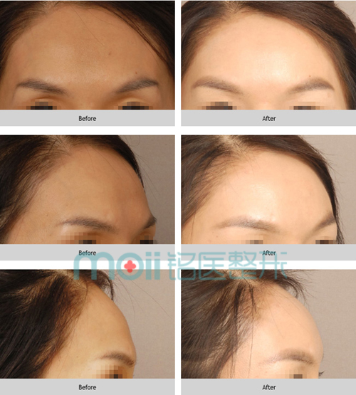 额头,丰额头,对比图,长春好的整形医院